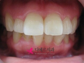  서면치아교정 돌출치아 바로잡기