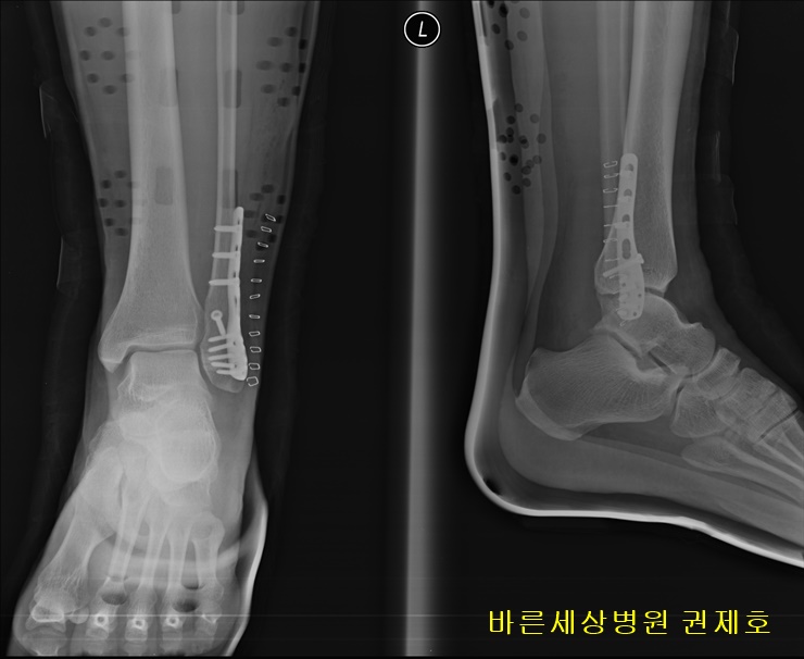 발목 골절, 개방적 정복술 및 내고정술 - 달리기 하는 중에 빙판길에 넘어지면서 발목이 꺽인 후 발생한 발목 골절 치료 / 바른세상병원 권제호