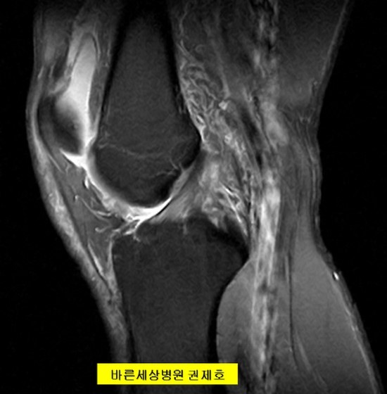  후방 십자 인대 파열로 관절경을 이용한 후방십자인대 재건술을 PCLR 시행한 경우 제이본정형외과 권제호