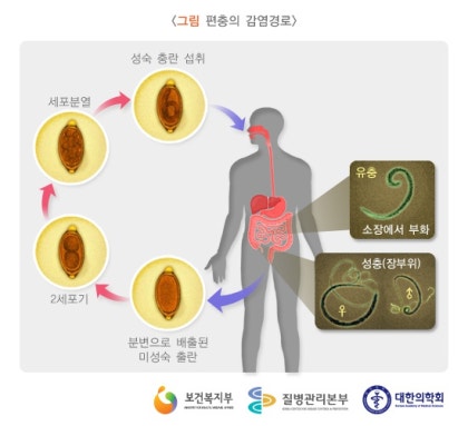 인간 편충 증상