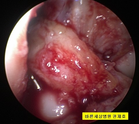  군대에서 축구하는 중 공을 잘못 밟은 후 무릎이 꺽이면서 '뚝'! #무릎 전방십자인대 파열로 재건술 받고 의가사 전역 #제이본정형외과 권제호