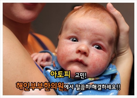 물 알레르기의 초기 증상 7