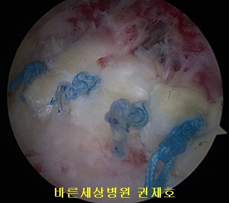  오십견으로 방치된 회전근개파열로 회전근개봉합술 제이본정형외과 권제호