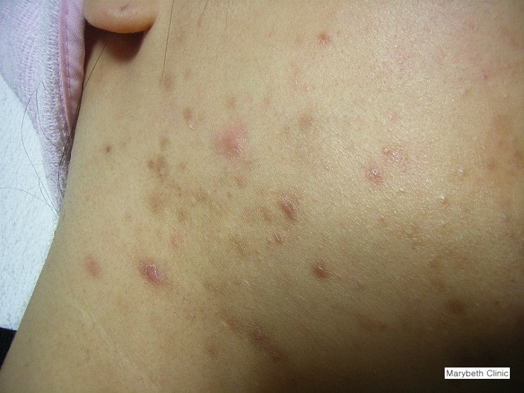168. 염증후과색소침착 (炎症後過色素沈着, Postinflammatory hyperpigmentation) - 피부질환 백과사전 : 네이버 블로그