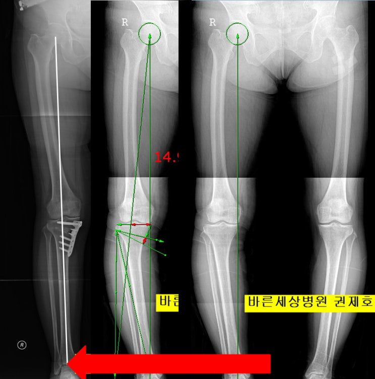 서울바른세상병원 무릎의 연골판이 찢어지고 연골이 닳게 되어 무릎 휜 다리가 동반되어 통증이 악화된 경우 어떤 치료가 좋을까요? 무릎 전문병원 권제호