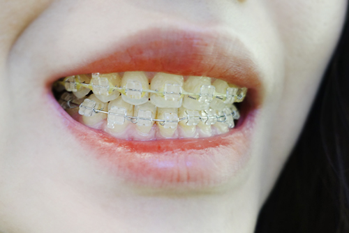 후기개방부정맥교정/클리어리테이너&이갈기 부목비용/측두하악관절(측두하악관절) 추간판 1