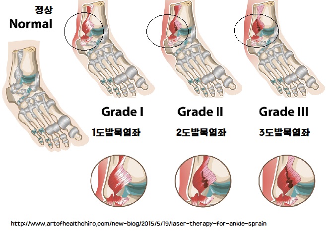 발목염좌 증상 자세히 알아보아요