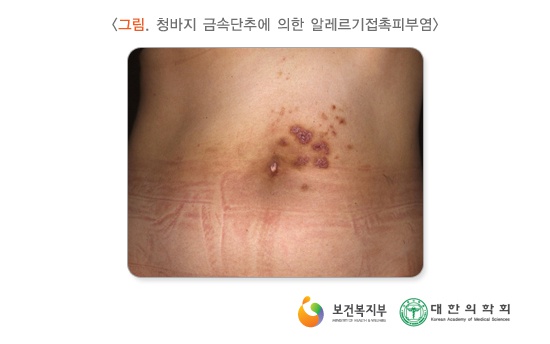 금속 알레르기 쇠독 증상 어떻게