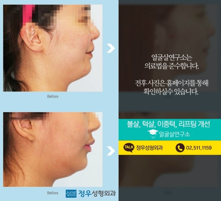 이중턱살제거 지방흡입 확실하게! 얼굴살연구소에서 : 네이버 블로그