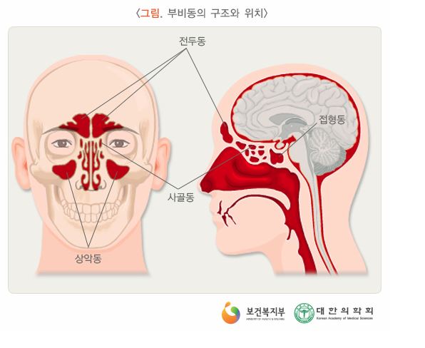 ■ 부비강염의(​Chronic sinusitis,副鼻腔炎) 정체