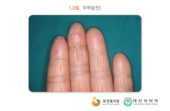 경산습진치료 민간요법 대신 피부과에서 2