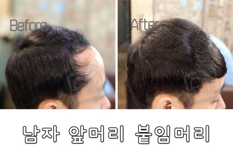  숱 없는 남자 앞머리 증모술은 퍼니M 스티커붙임머리로 티 안 나는 머리숱증모 30분 끝!