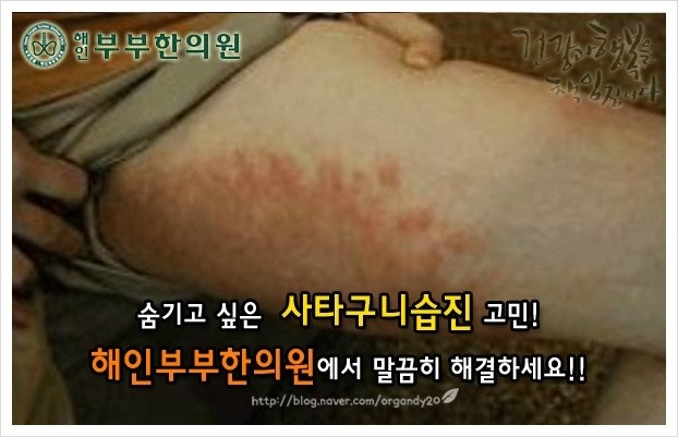 수원 사타구니 습진 원인은?