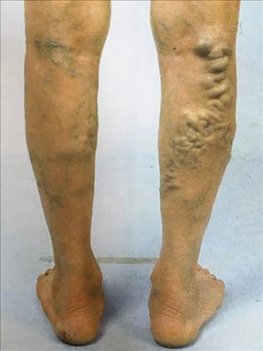 하지정맥류 수술, 실손보험 제외에 의료계 반발 거세져 하지정맥류 수술, 실손보험 제외에 의료계 반발 거세져