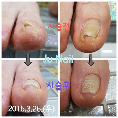 분당용인보정수지죽전네일/주네일/파고드는발톱교정.내향성발톱교정