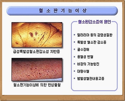 혈소판 수치 감소의 원인 증상을 반드시 알아야 하는 이유