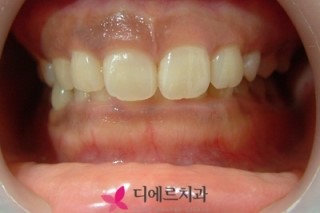  부산잇몸성형 잇몸은 넓어보이고 치아가 짧아보이는 고민