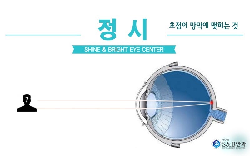 [건강칼럼]정시, 근시, 원시, 난시란?