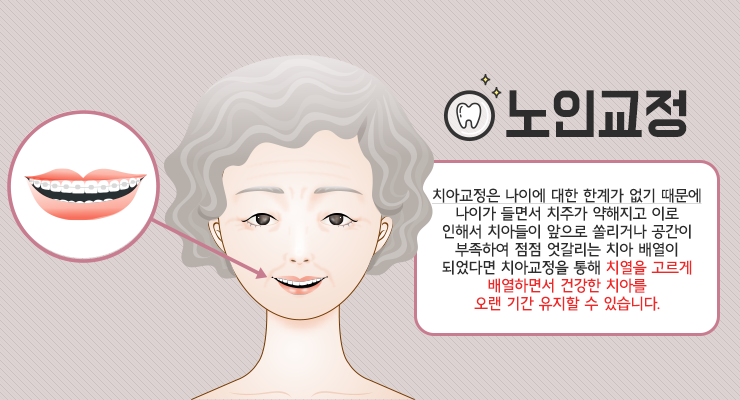 치아 교정 치료의 적기 시기를 정하는 방법은? 6