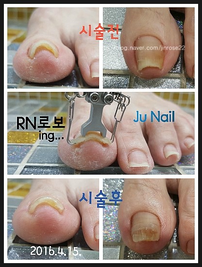 분당용인보정수지죽전네일/주네일/파고드는발톱교정.내향성발톱교정 분당용인보정수지죽전네일/주네일/파고드는발톱교정.내향성발톱교정