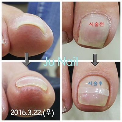 분당용인보정수지죽전네일/주네일/파고드는발톱교정.내향성발톱교정 분당용인보정수지죽전네일/주네일/파고드는발톱교정.내향성발톱교정