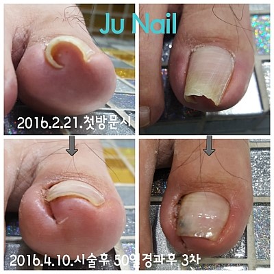 분당용인보정수지죽전네일/주네일/파고드는발톱교정.내향성발톱교정 분당용인보정수지죽전네일/주네일/파고드는발톱교정.내향성발톱교정
