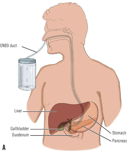 내시경적 검사치료 정리(ERCP, EST, ENBD, ERBD, PTBD) : 네이버 블로그