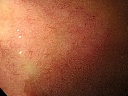 십이지장 궤양반흔(duodenal ulcer scar)