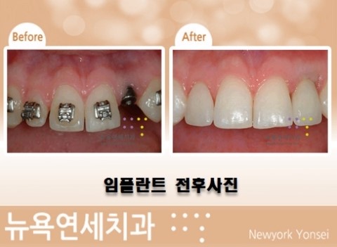  임플란트병원,임플란트치과병원,임플란트전문병원,임플란트병원비