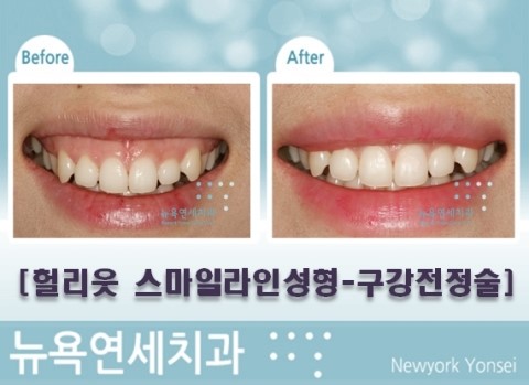  ###구강전정술,구강전정술치과,구강전정술비용,구강전정술가격***