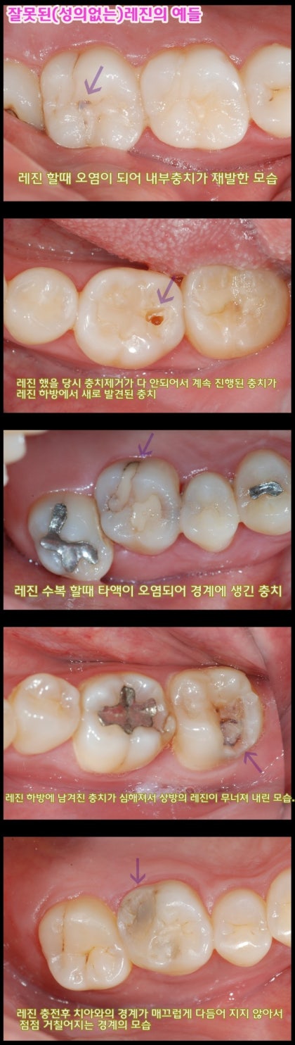 어금니 충치 치료법 레진 치료 비용 가격 9