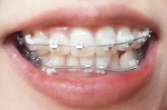 [교정 5] 교정 5일째, 치아가 가렵고 의도치 않은 썩소를 짓게 된다. (클리피씨/비발치교정/교정일기)