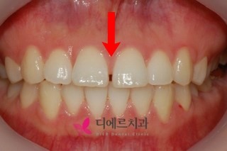  서면치아교정 여러시술법에 따른 전후사진