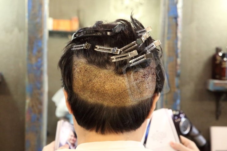  모재성 성형외과 남자 앞머리 모발이식 후 스티커 붙임머리