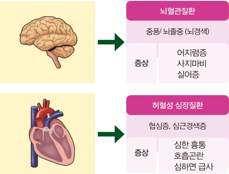 고지혈증 증상 원인 약 이상지질혈증의 오해와 진실!