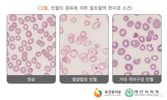빈혈 식생활 가이드, 철과 비타민 보충이 필수! - 부천서울여성병원 아이원센터 : 네이버 블로그