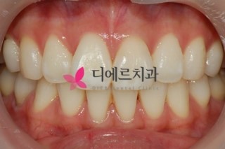  서면잇몸미백 선홍빛 잇몸으로 빛나는 여름을~