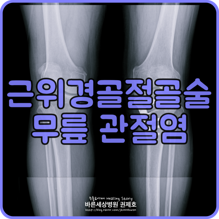  근위경골절골술 무릎연골재생술 : 중년 여성의 관절염 극복 이야기
