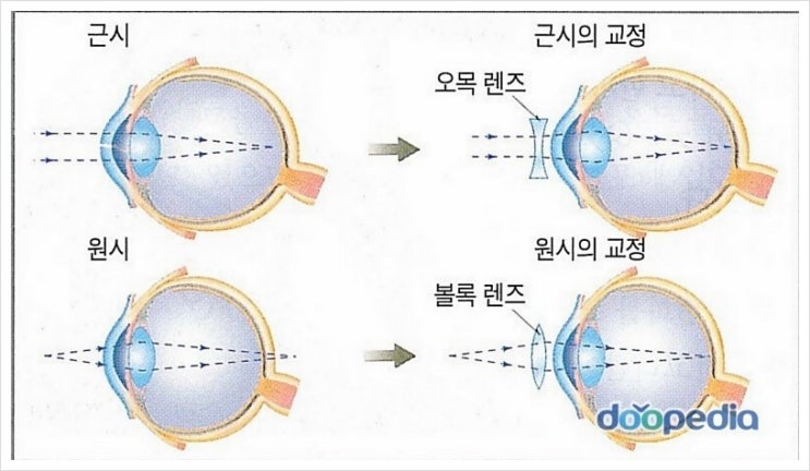 [건강칼럼]정시, 근시, 원시, 난시란? 8