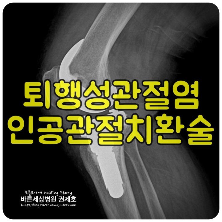  인공관절전치환술 퇴행성관절염 : 80대 강원도 할머니의 힘