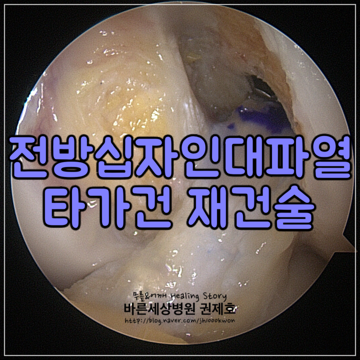  전방십자인대파열 타가건재건술 : 축구하다가 다친 무릎의 동요를 잡아야 한다