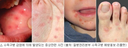 수족구 증상ㆍ예방ㆍ치료등 서울대학병원 11