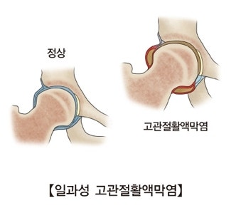 어린이 고관절 통증 및 골반, 가랑이, 허벅지 안쪽 통증  : 일과성 고관절 활액막염 증상 및 치료