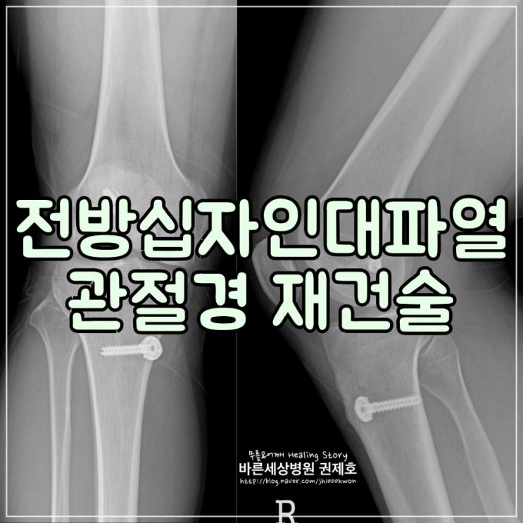 전방십자인대파열 무릎관절내시경 : 방치된 무릎동요로 인한 이차 손상
