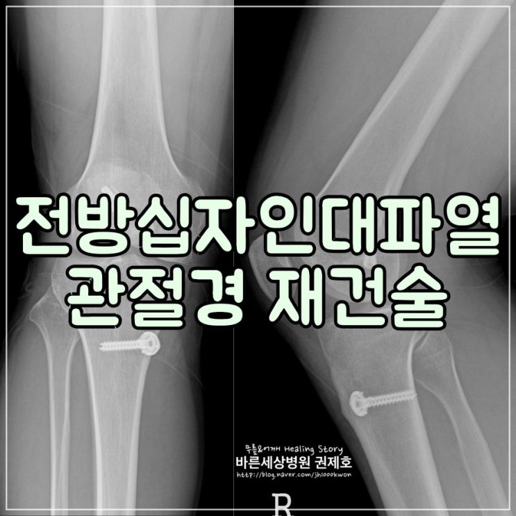  전방십자인대파열 무릎관절내시경 : 방치된 무릎동요로 인한 이차 손상