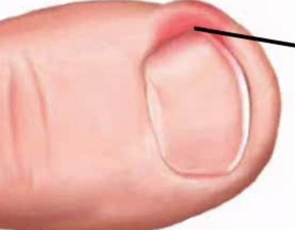  내향성 발톱 치료법, 집에서 자가치료...