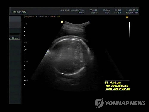 태아 보장 않는 태아보험…금감원, 보험사에 시정요구 태아 보장 않는 태아보험…금감원, 보험사에 시정요구