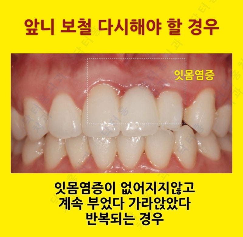 치은염의 고름에 대처하는 방법 6