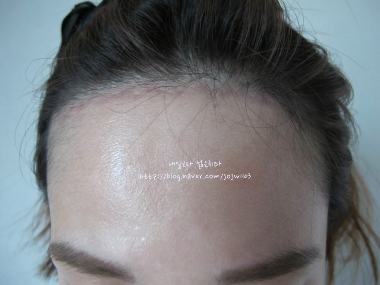이마 축소 수술 후기(회복 기간, 상처, 비용), 이마 반M자 탈모 탈출기. 2