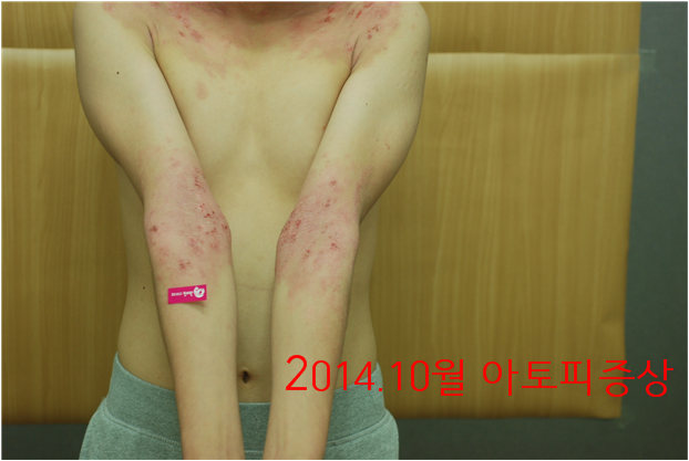 아토피 흉터를 치료하는 방법 4